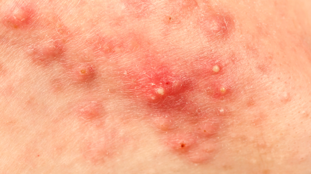 Erythropoieticprotoporphyria.jpg